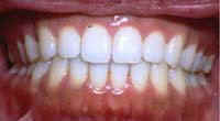 Close-up of an Invisalign® case