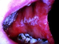 oral yeast infection