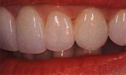 Dental bridge work by Dr. Hall to fix ovate pontic