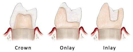 porcleain onlays compared