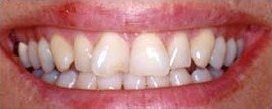 Crooked front teeth - before