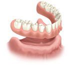 immediate lower denture 