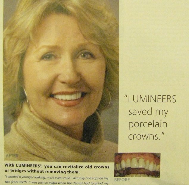 Lumineers over crowns ad