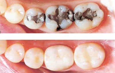 amalgam tooth fillings replaced with white composite fillings