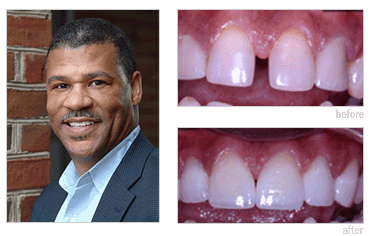 Another example of DURAthin veneers before and afters