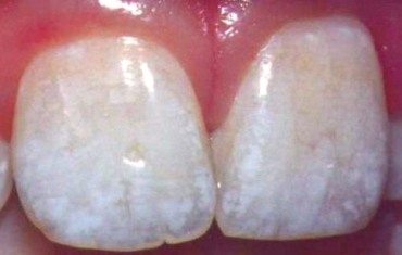 Close-up of fluorosis stained teeth