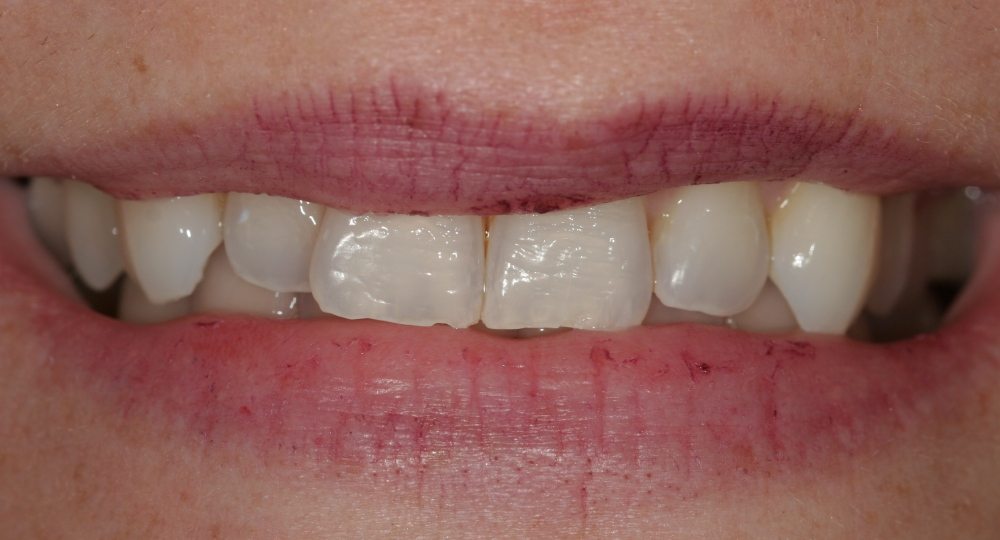 Teeth are crowded, chipped, pitted and out of proportion - before