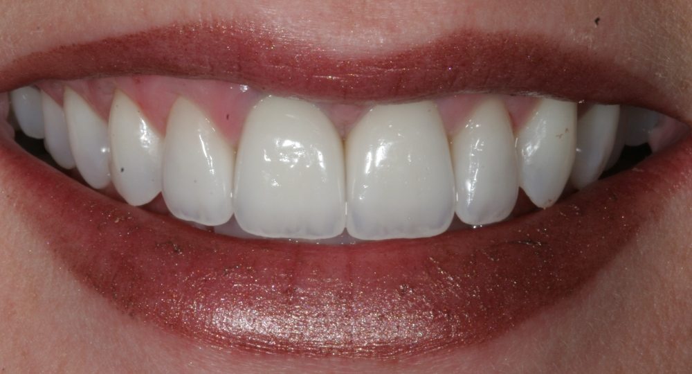 Dark tooth corrected with porcelain veneers - after