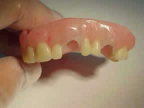 cu-sil partial denture side view