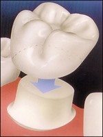 A dental crown