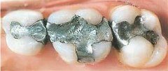 should this tooth have a filling or a crown?
