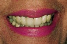 Before - Porcelain-fused-to-metal crowns